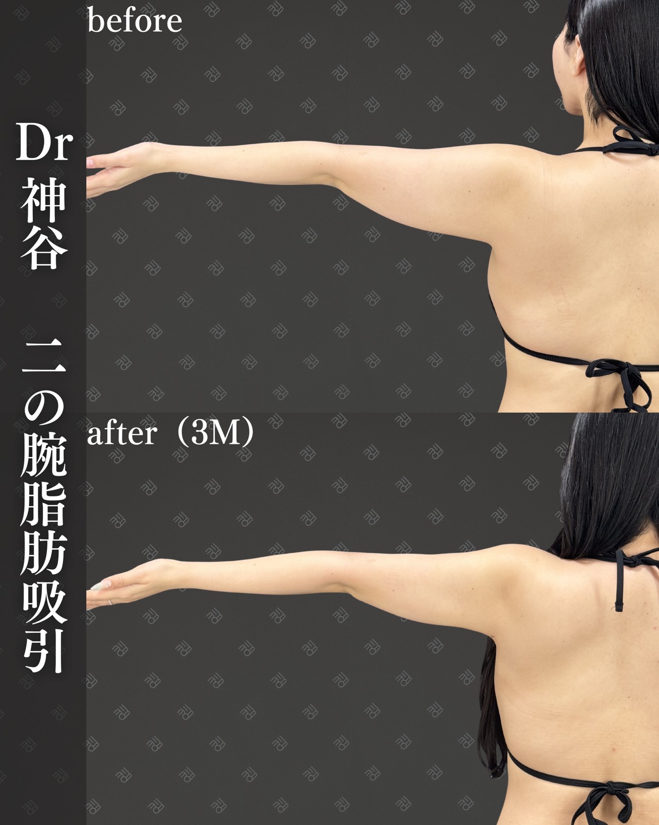 二の腕脂肪吸引ー症例写真