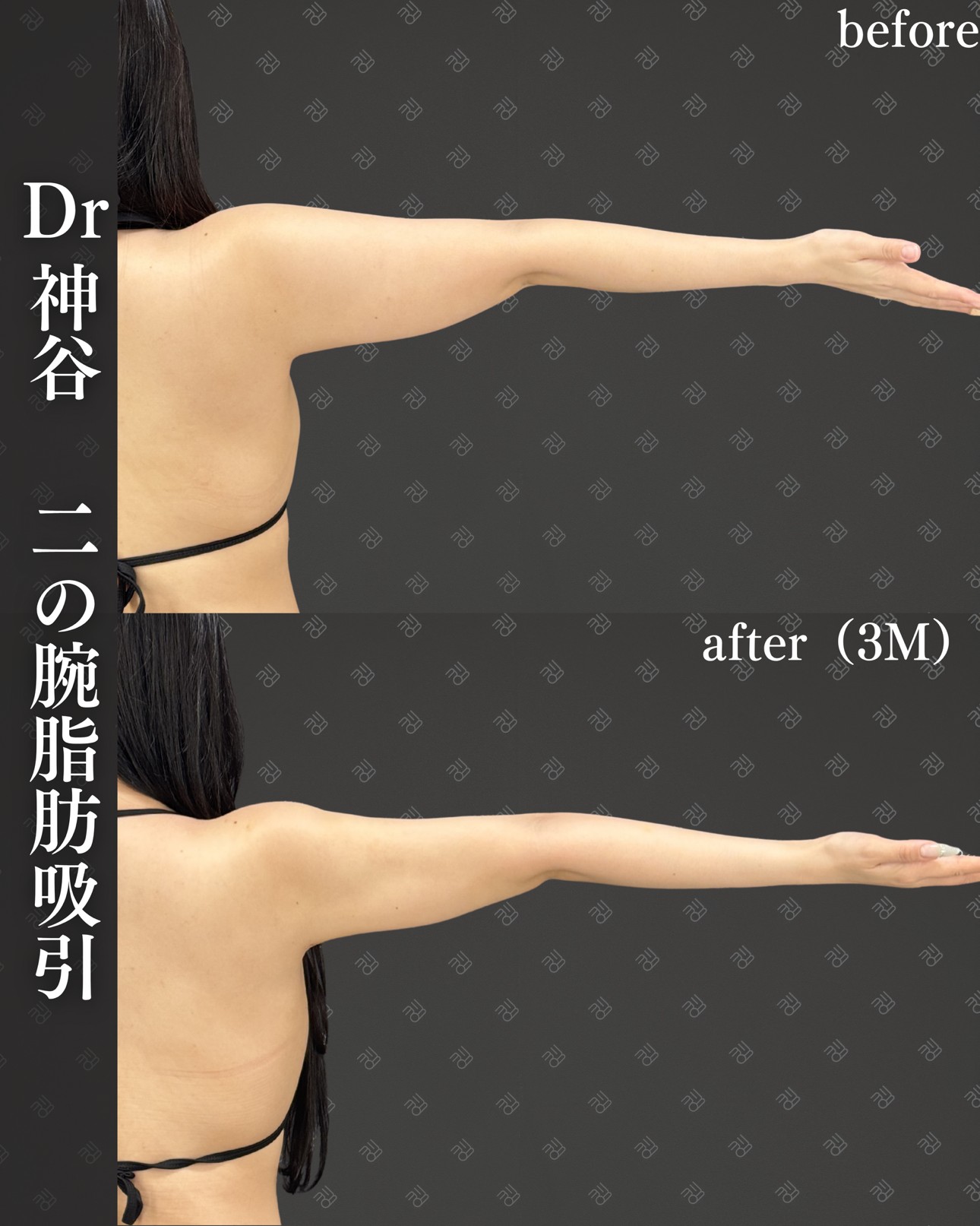 二の腕脂肪吸引ー症例写真