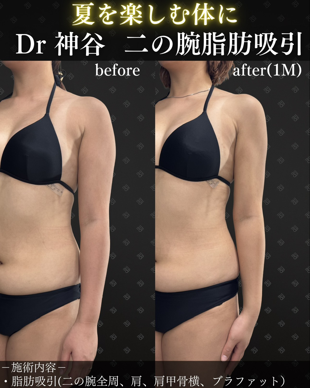 二の腕脂肪吸引ー症例写真