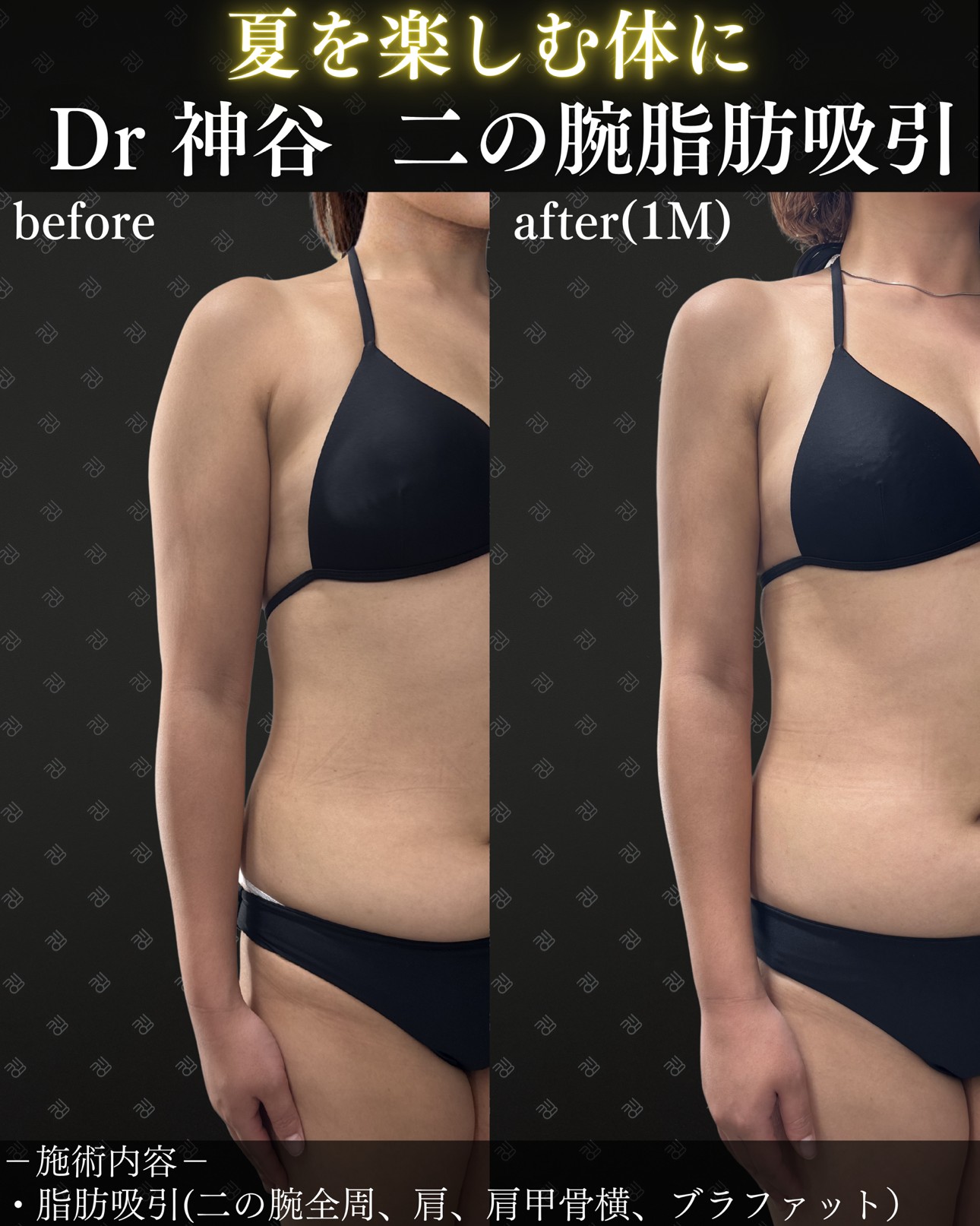 二の腕脂肪吸引ー症例写真