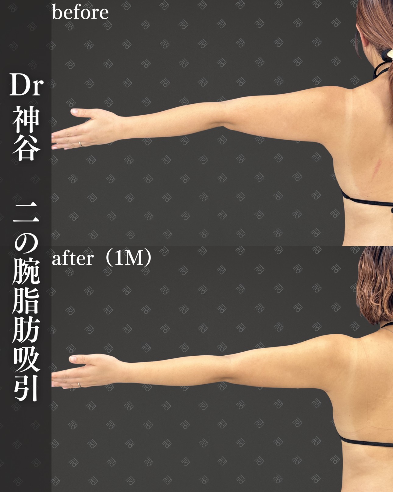 二の腕脂肪吸引ー症例写真