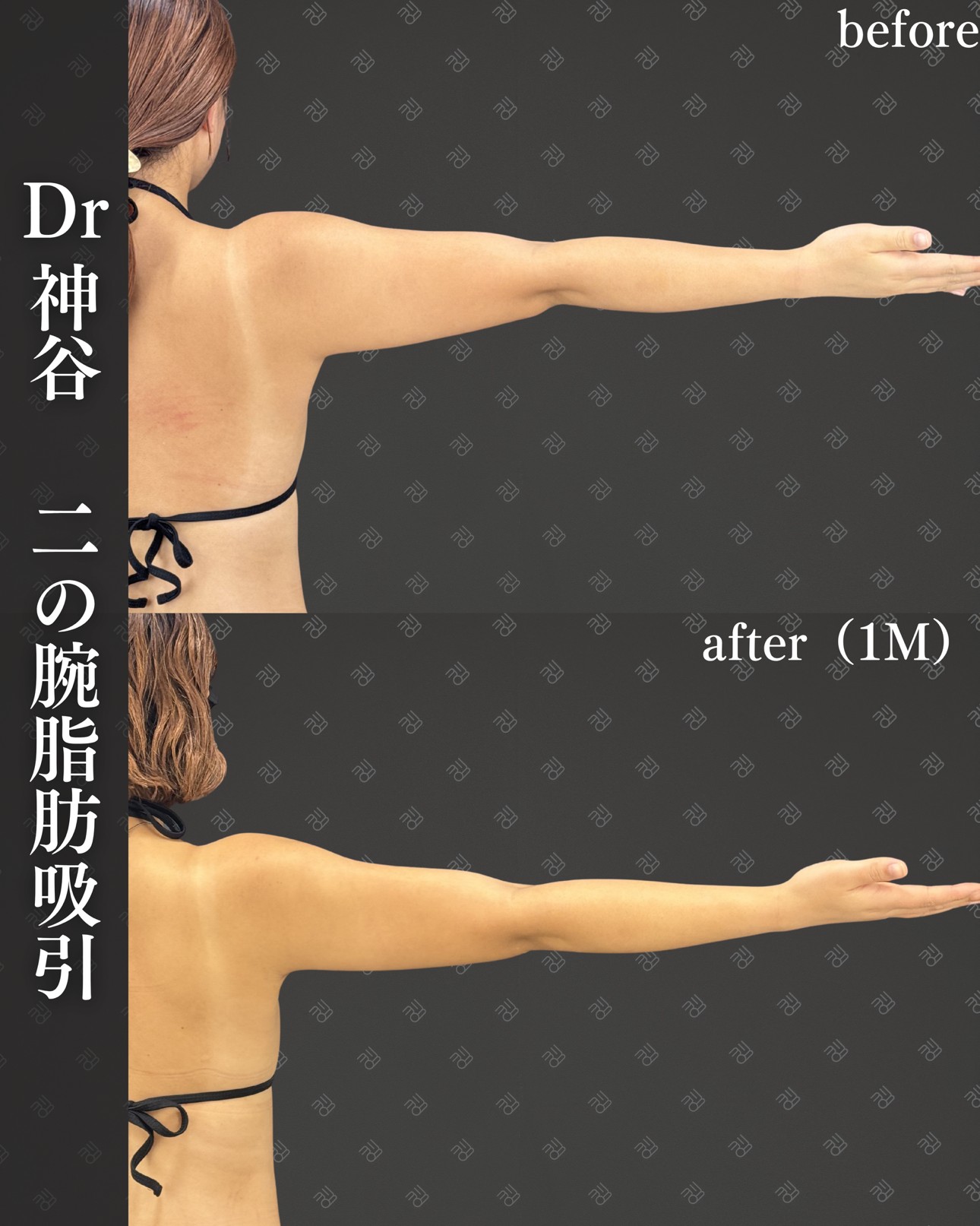 二の腕脂肪吸引ー症例写真