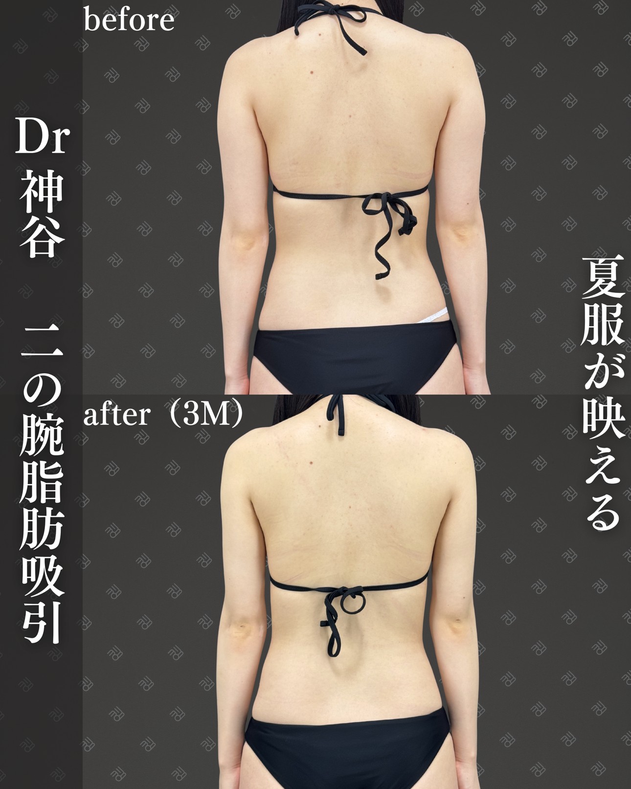 二の腕脂肪吸引ー症例写真