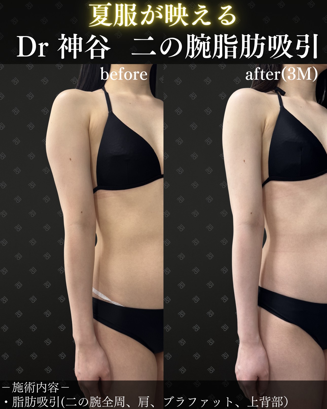 二の腕脂肪吸引ー症例写真