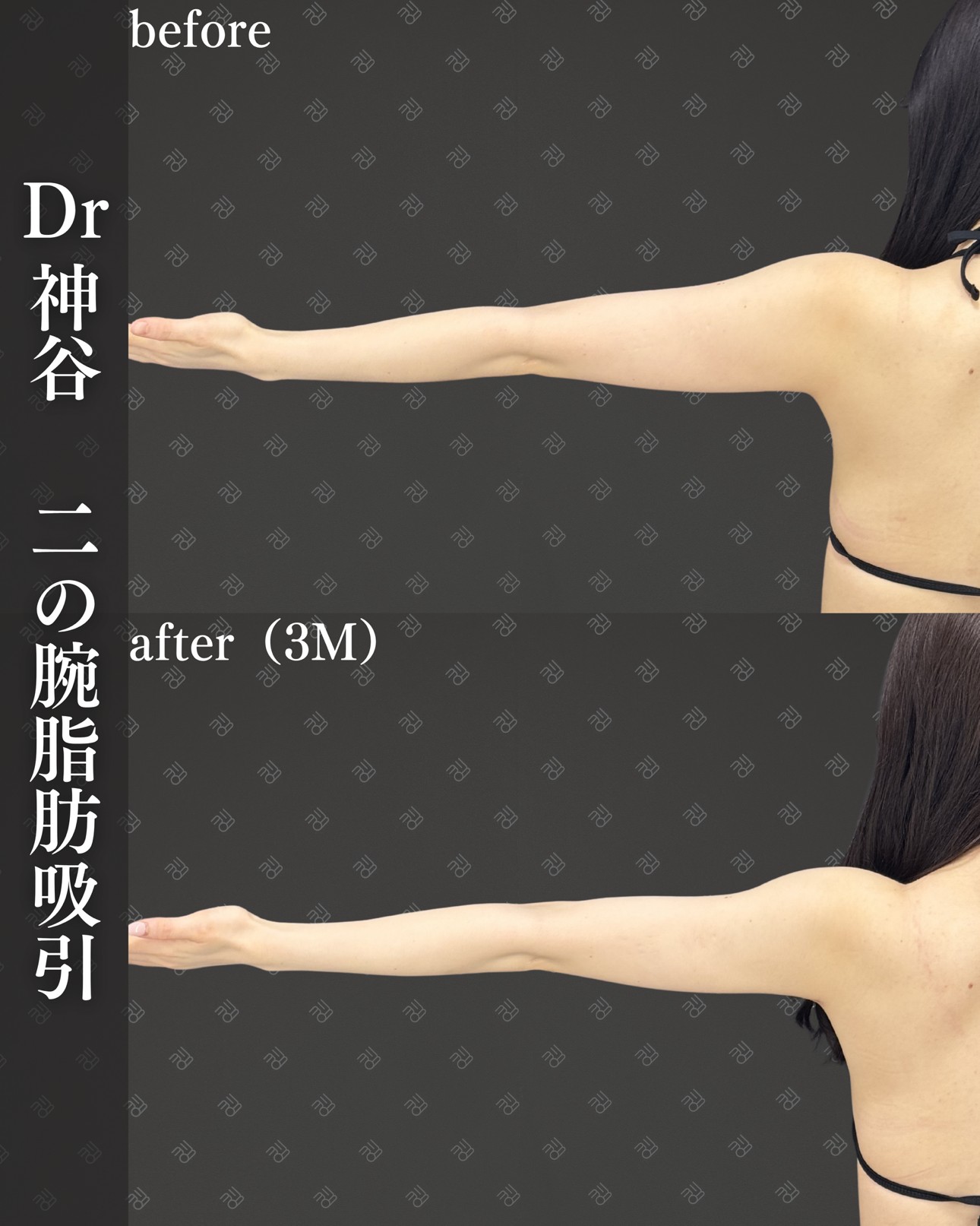 二の腕脂肪吸引ー症例写真
