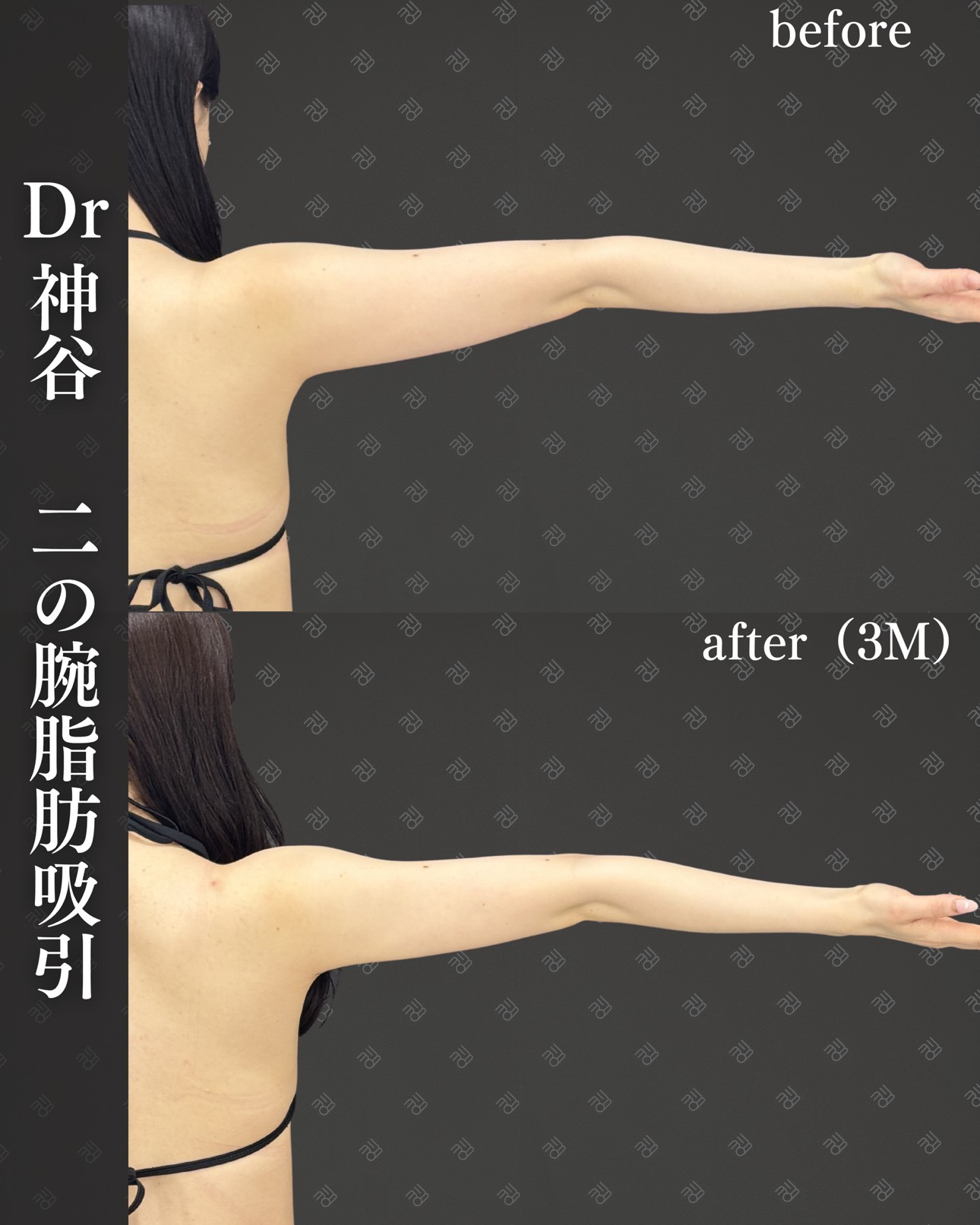 二の腕脂肪吸引ー症例写真