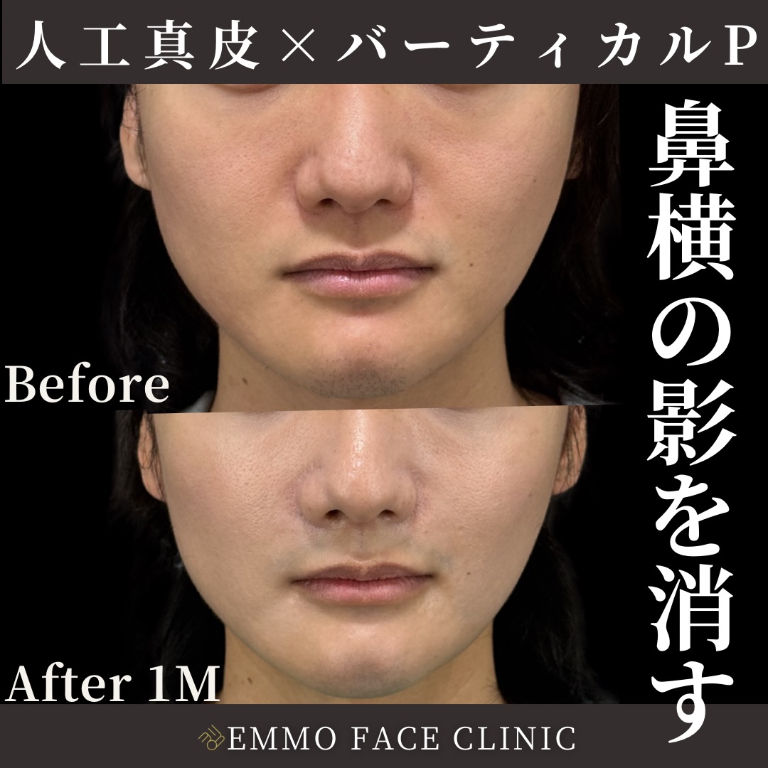 人工真皮×バーティカルリフトプレミアム