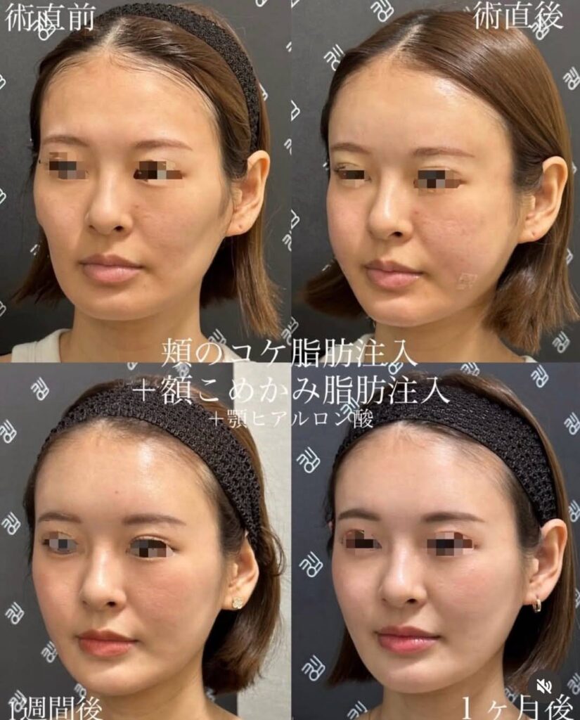 顔の脂肪吸引 症例写真