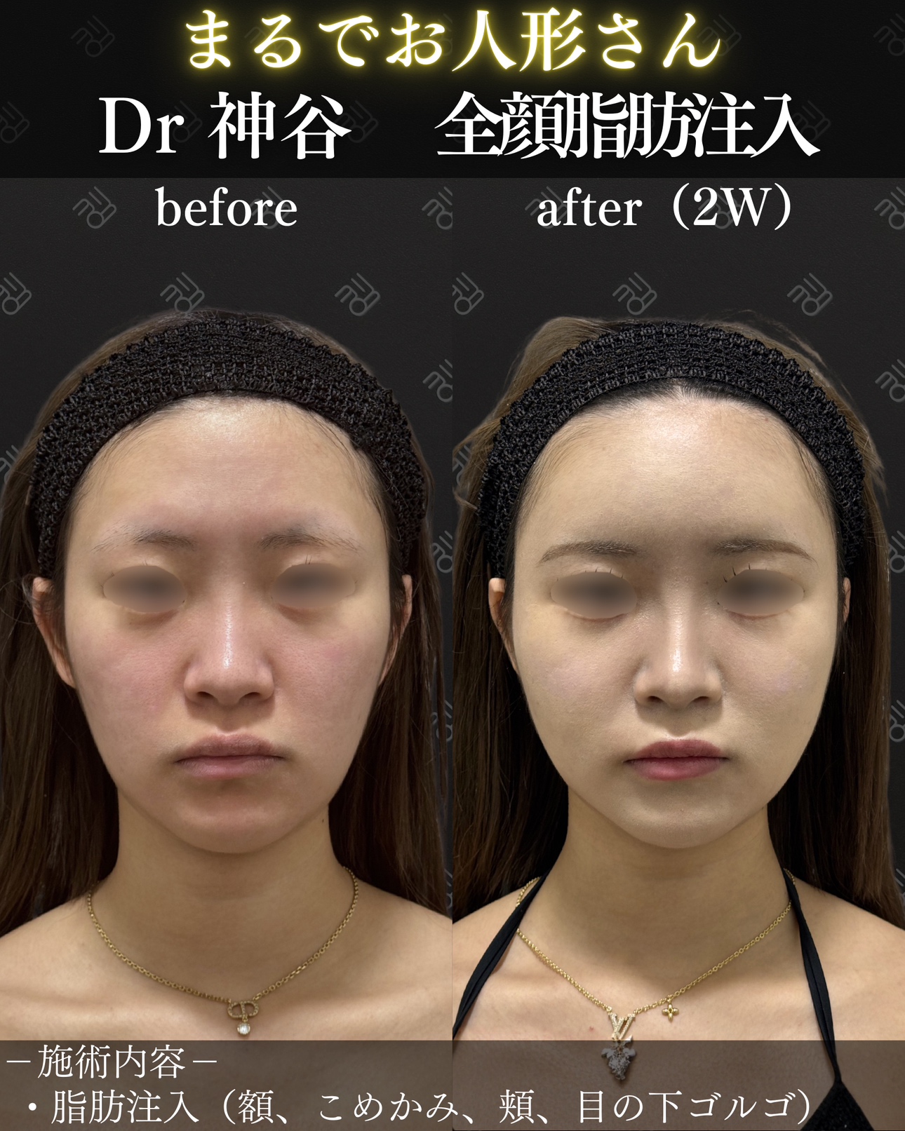 脂肪注入ー症例写真