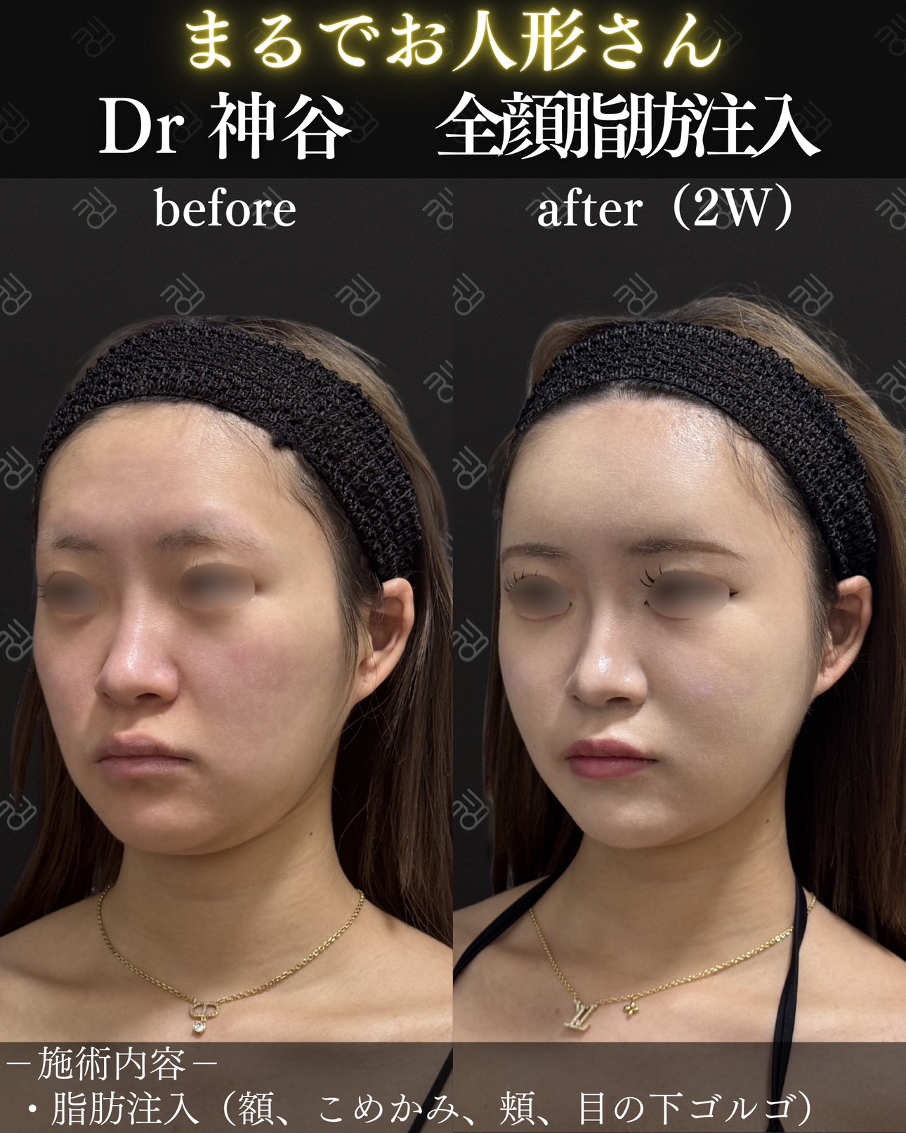 脂肪注入ー症例写真