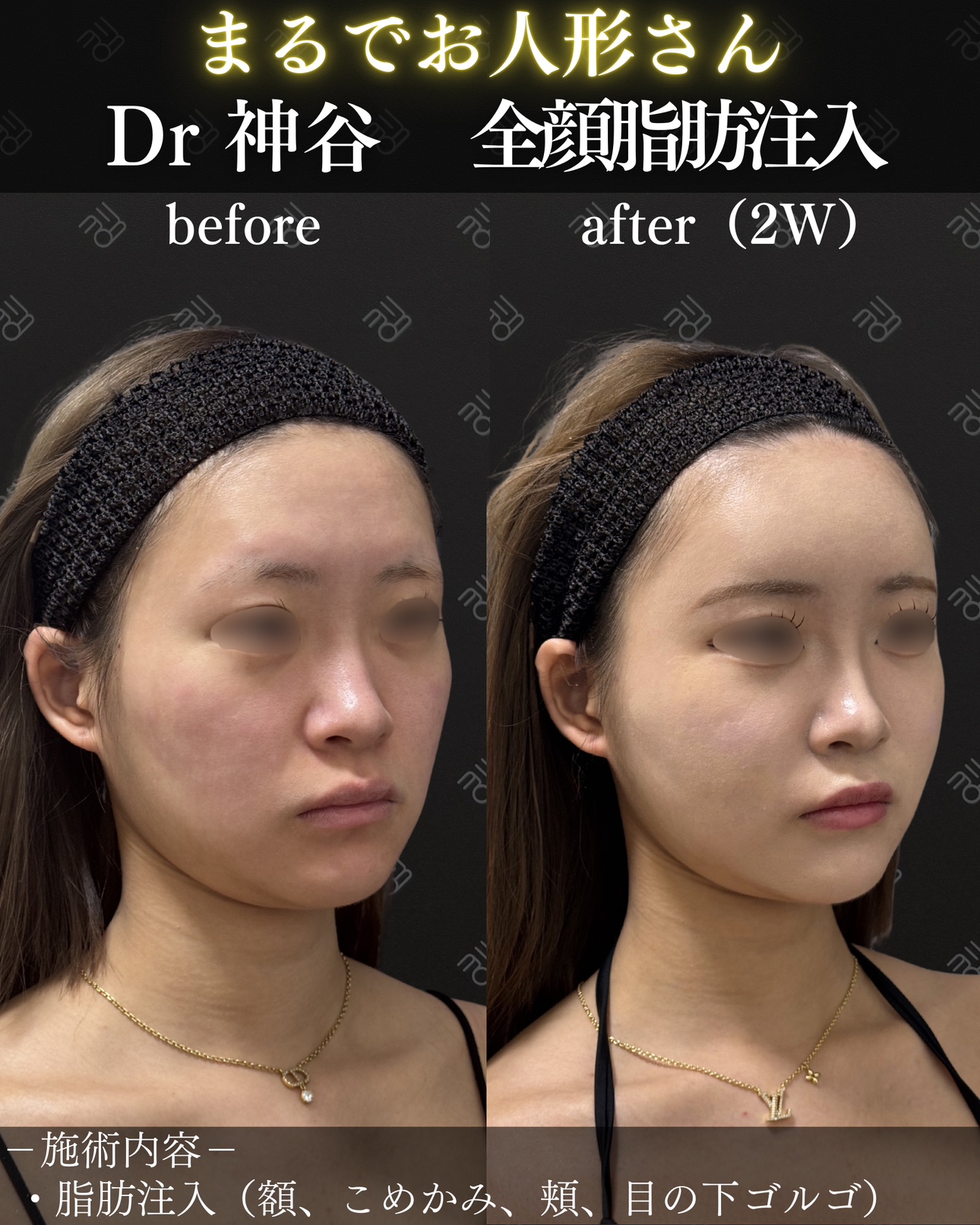脂肪注入ー症例写真