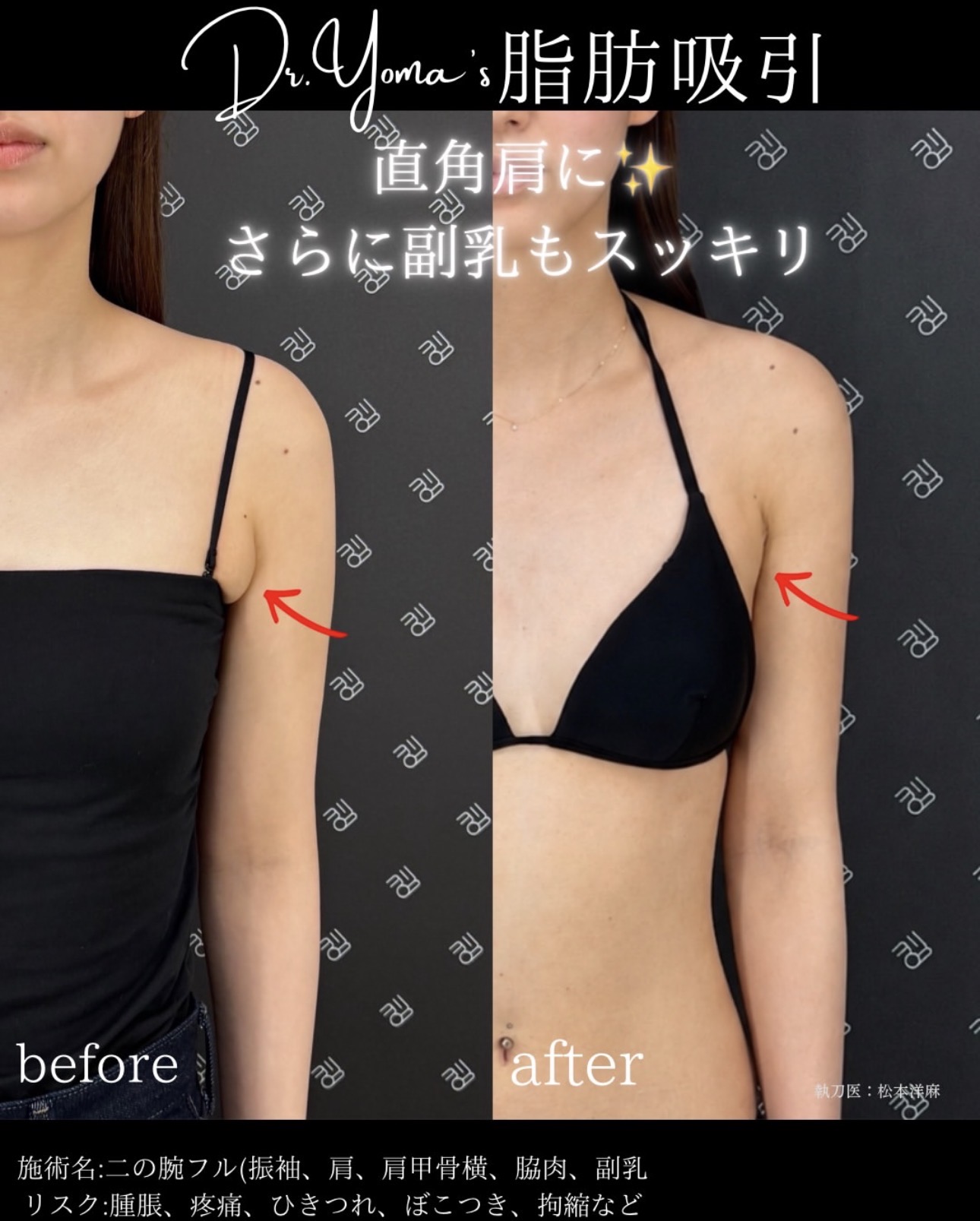 二の腕脂肪吸引ー症例写真