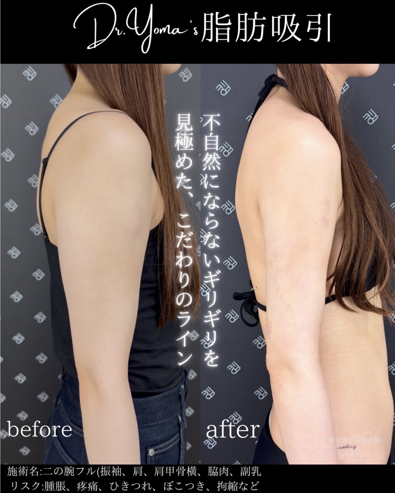 二の腕脂肪吸引ー症例写真