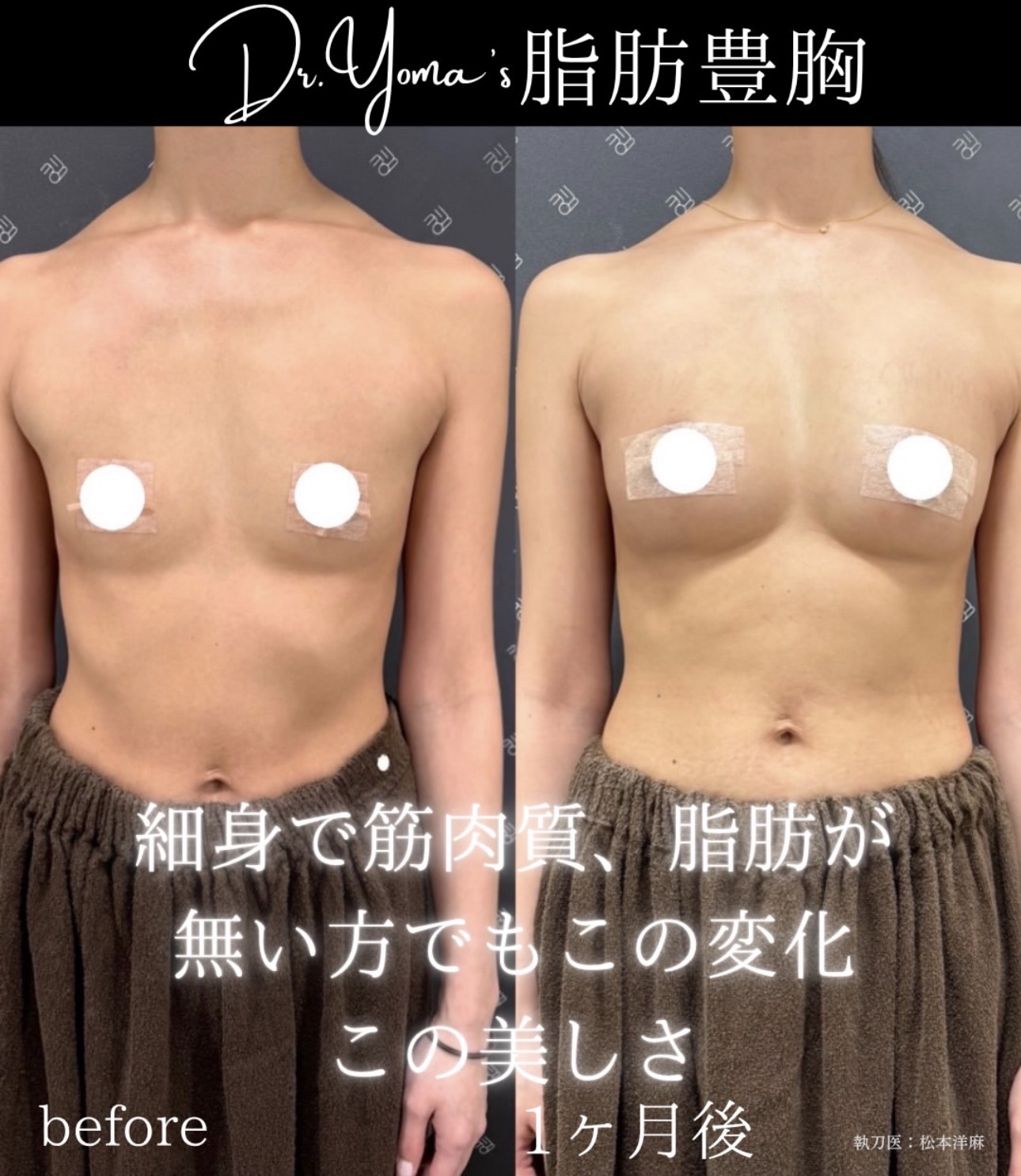脂肪豊胸ー症例写真