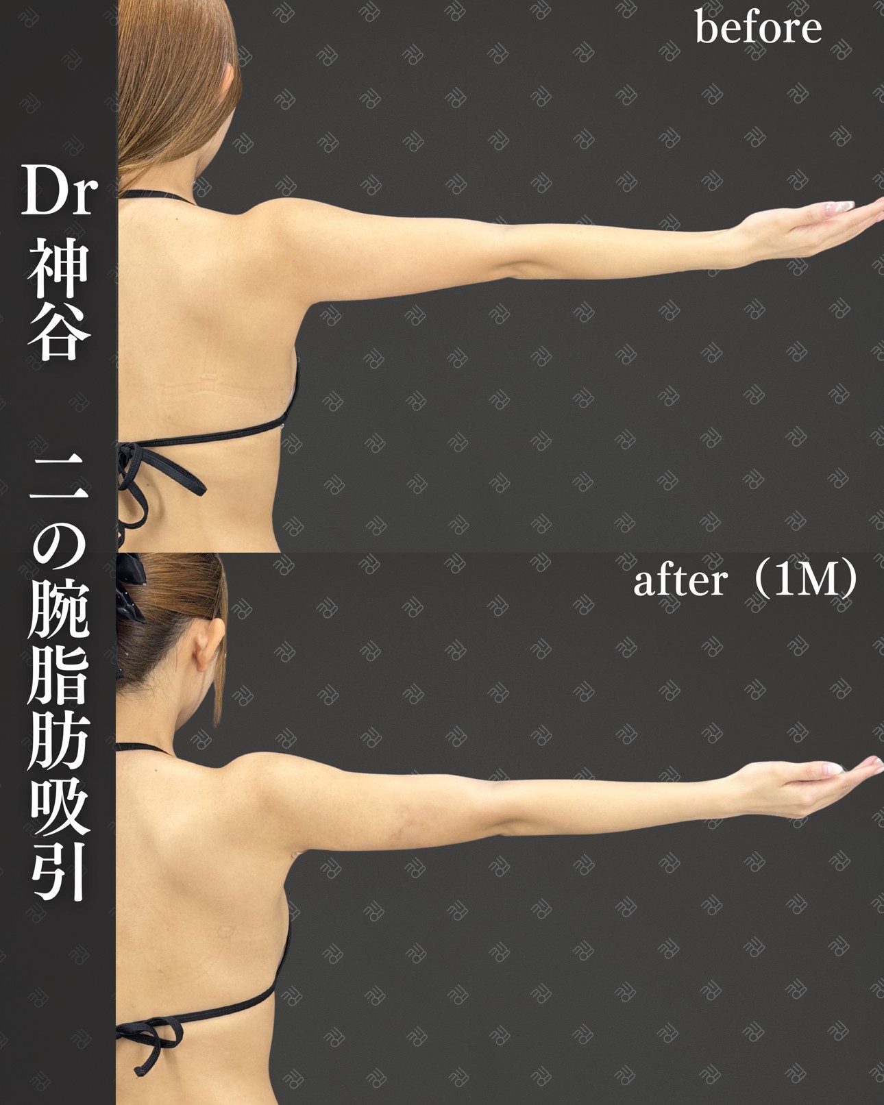 脂肪吸引ー症例写真