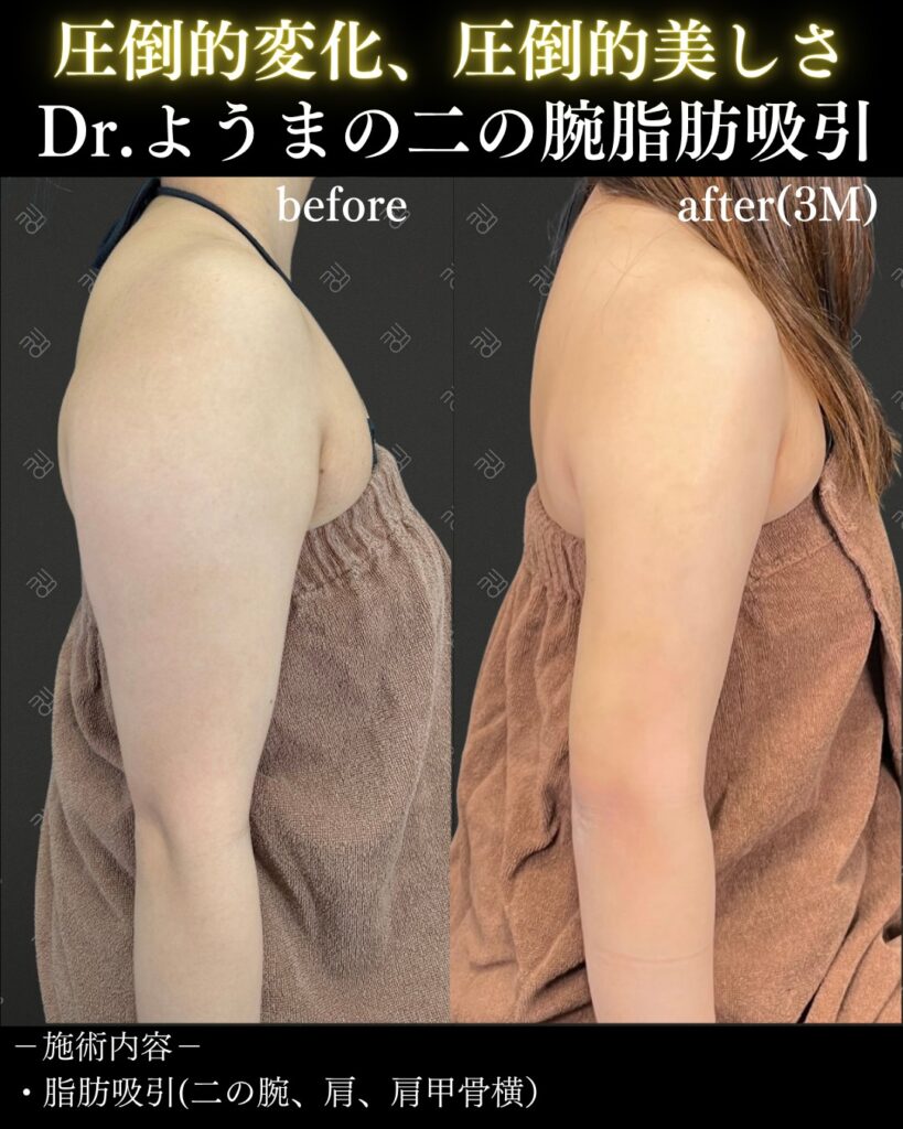 二の腕の脂肪吸引のビフォーアフター01
