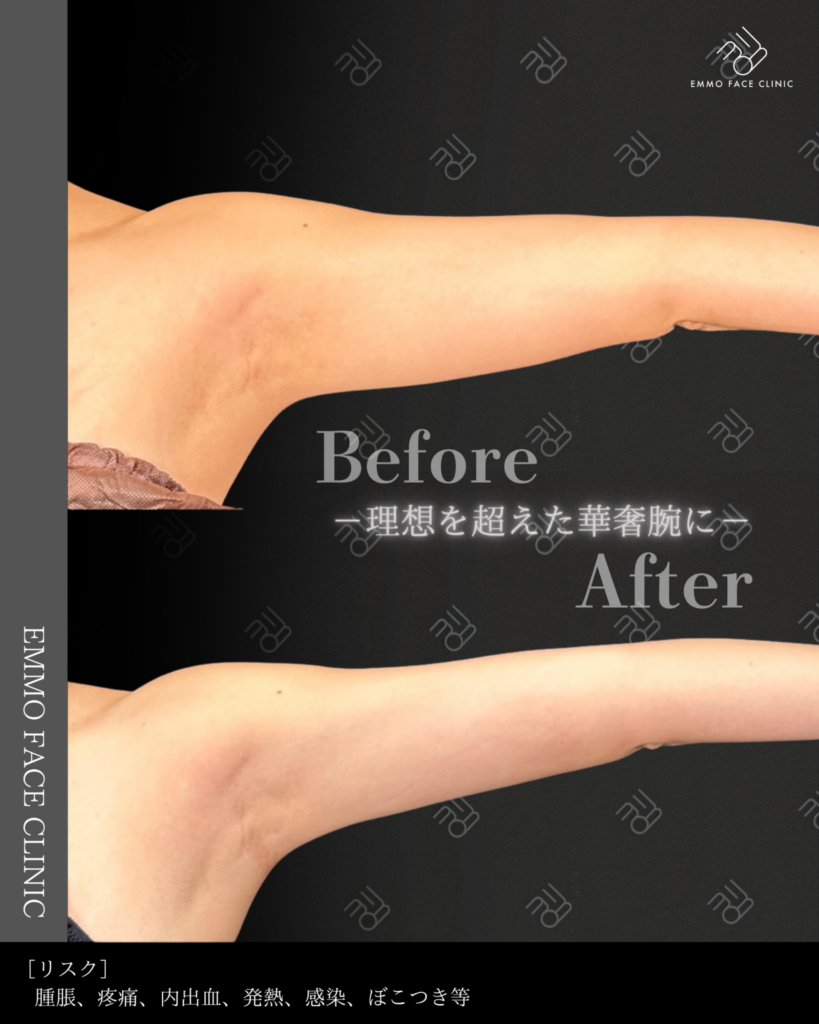 二の腕脂肪吸引のビフォーアフター（正面）