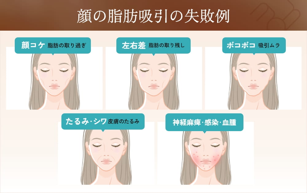顔の脂肪吸引失敗例のイラスト
