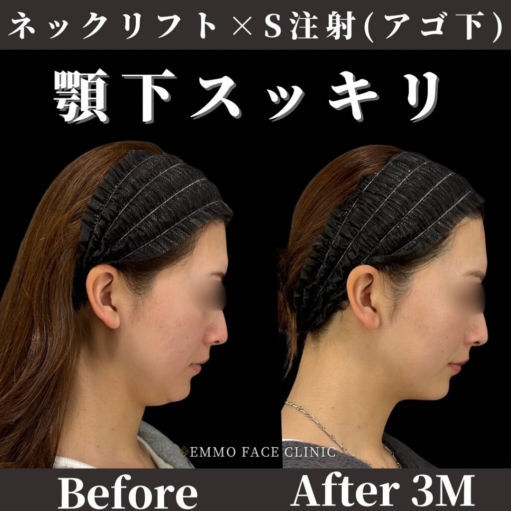 顔の輪郭整形手術のビフォーアフター
