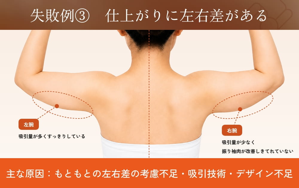 腕の脂肪吸引後の左右差を示す図
