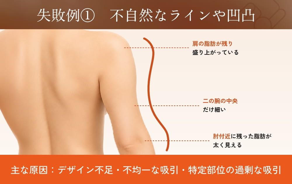 脂肪吸引後の不自然な腕のラインと凹凸