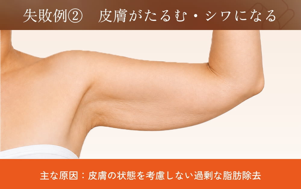 二の腕のたるんだ皮膚