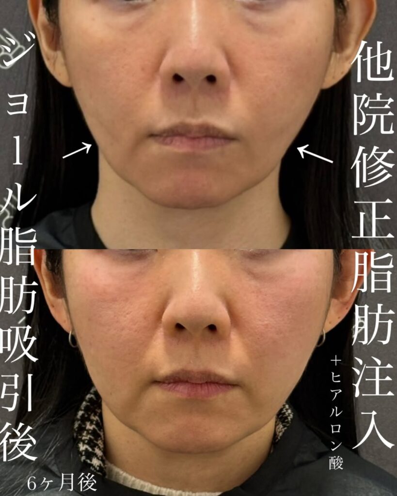 ジョール脂肪吸引の修正のビフォーアフター