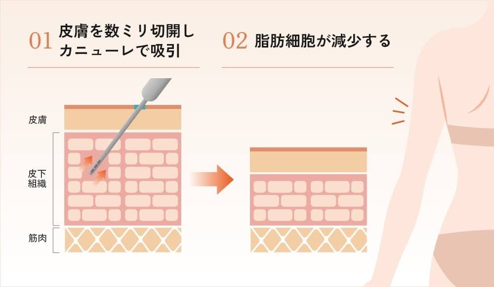 脂肪吸引による皮下組織の変化を示す図