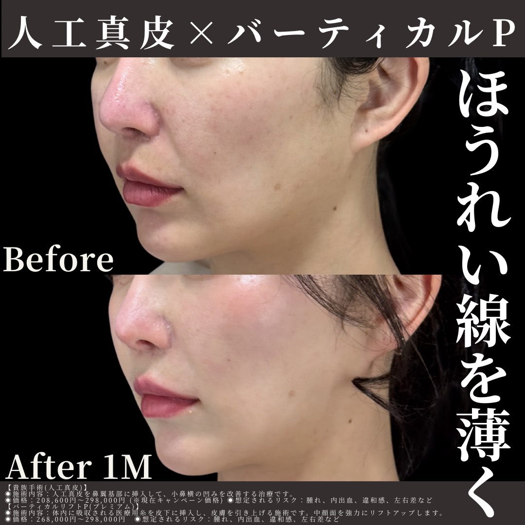 人工真皮×バーティカルリフトプレミアム