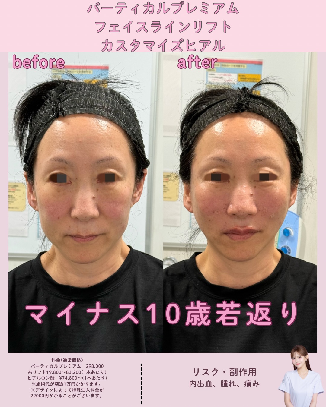 バーティカルリフトプレミアム×フェイスラインリフト×カスタマイズヒアル