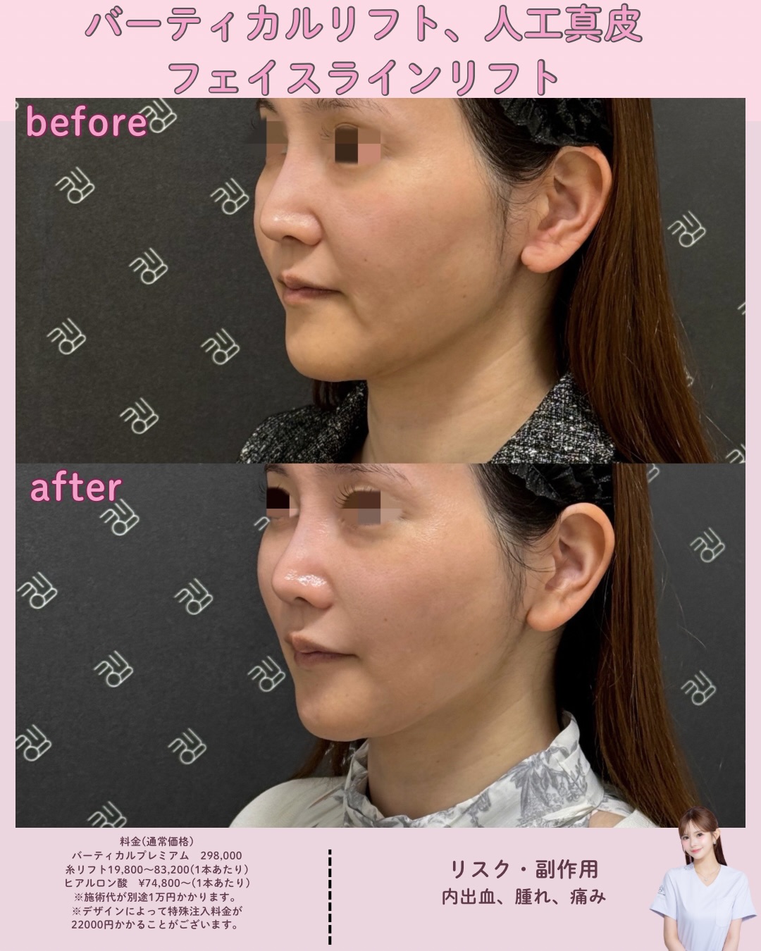 バーティカルリフトプレミアム×人工真皮×糸リフト