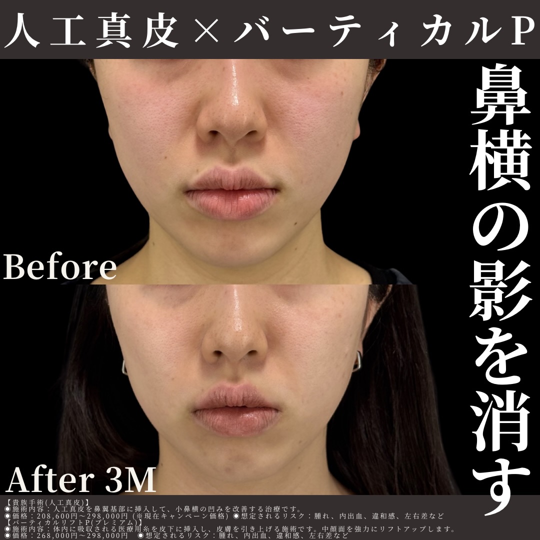 人工真皮×バーティカルリフトプレミアム