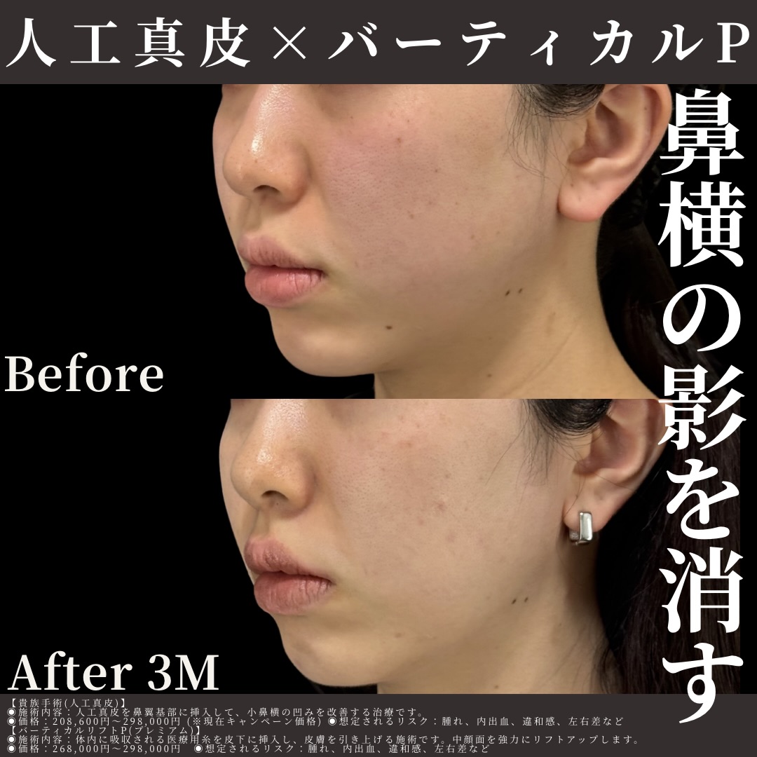 人工真皮×バーティカルリフトプレミアム