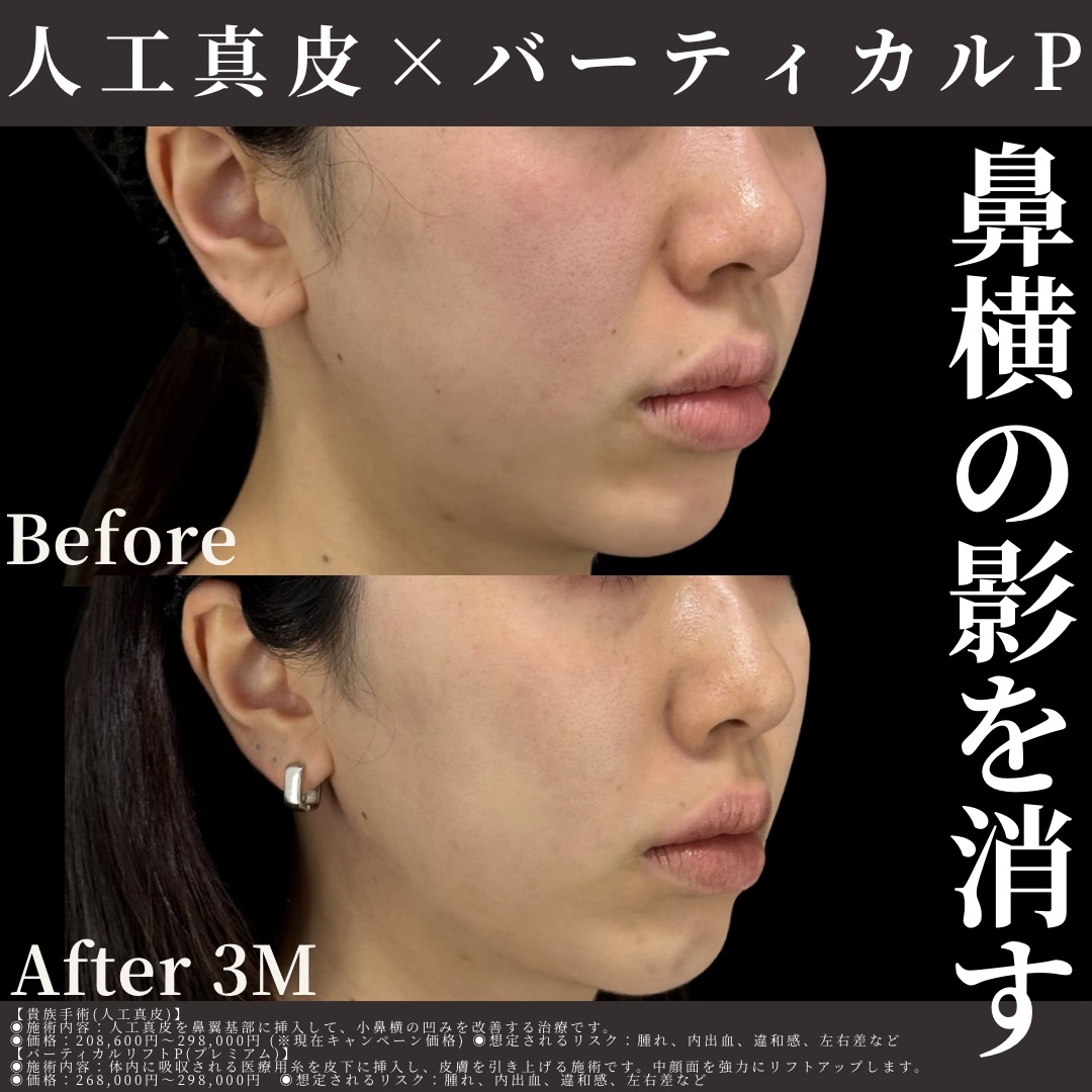 人工真皮×バーティカルリフトプレミアム