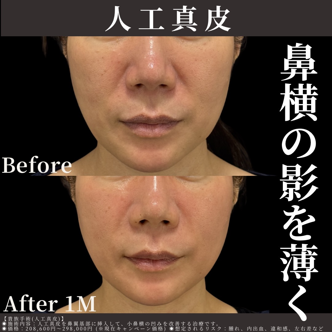 人工真皮