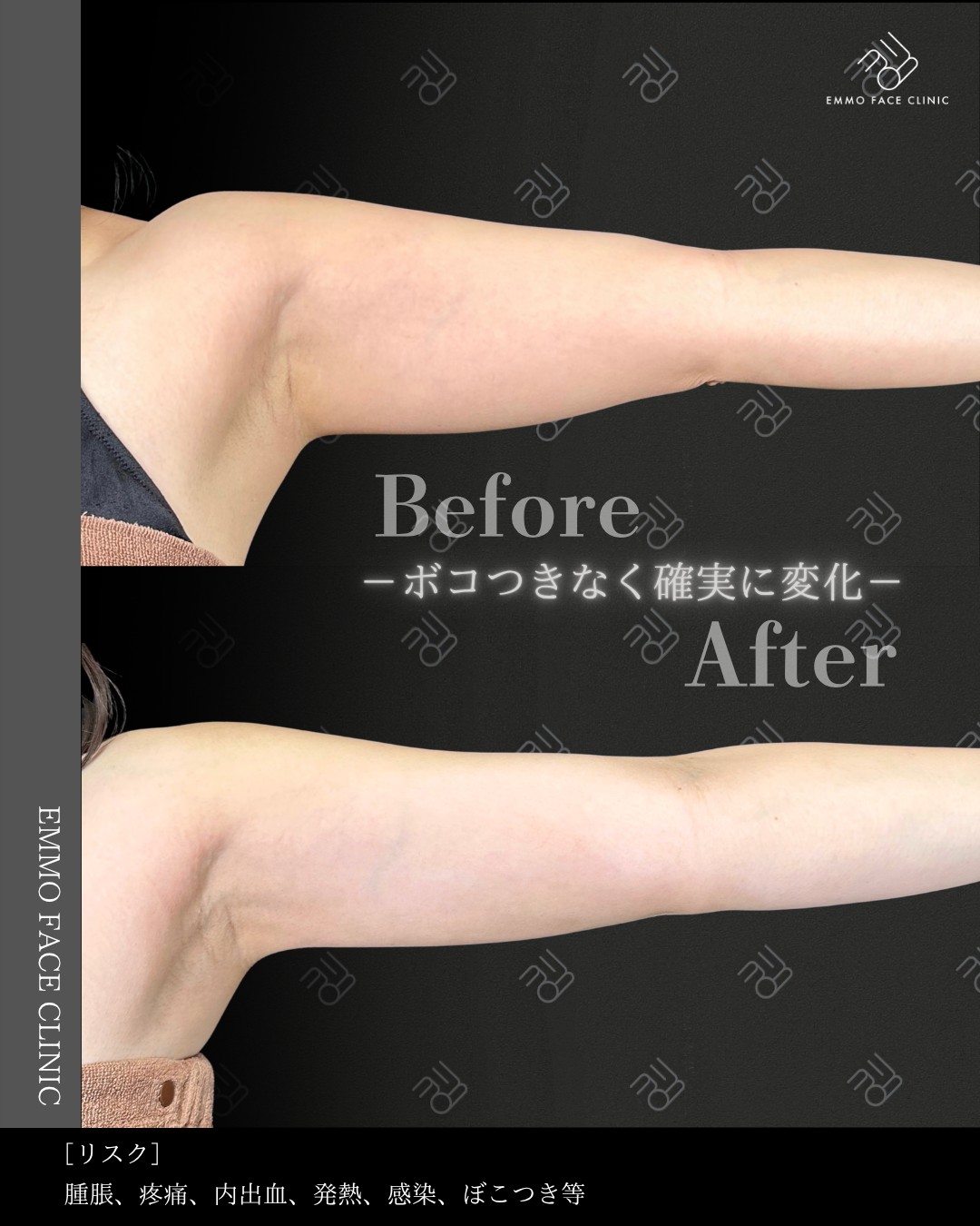 二の腕脂肪吸引ー症例写真