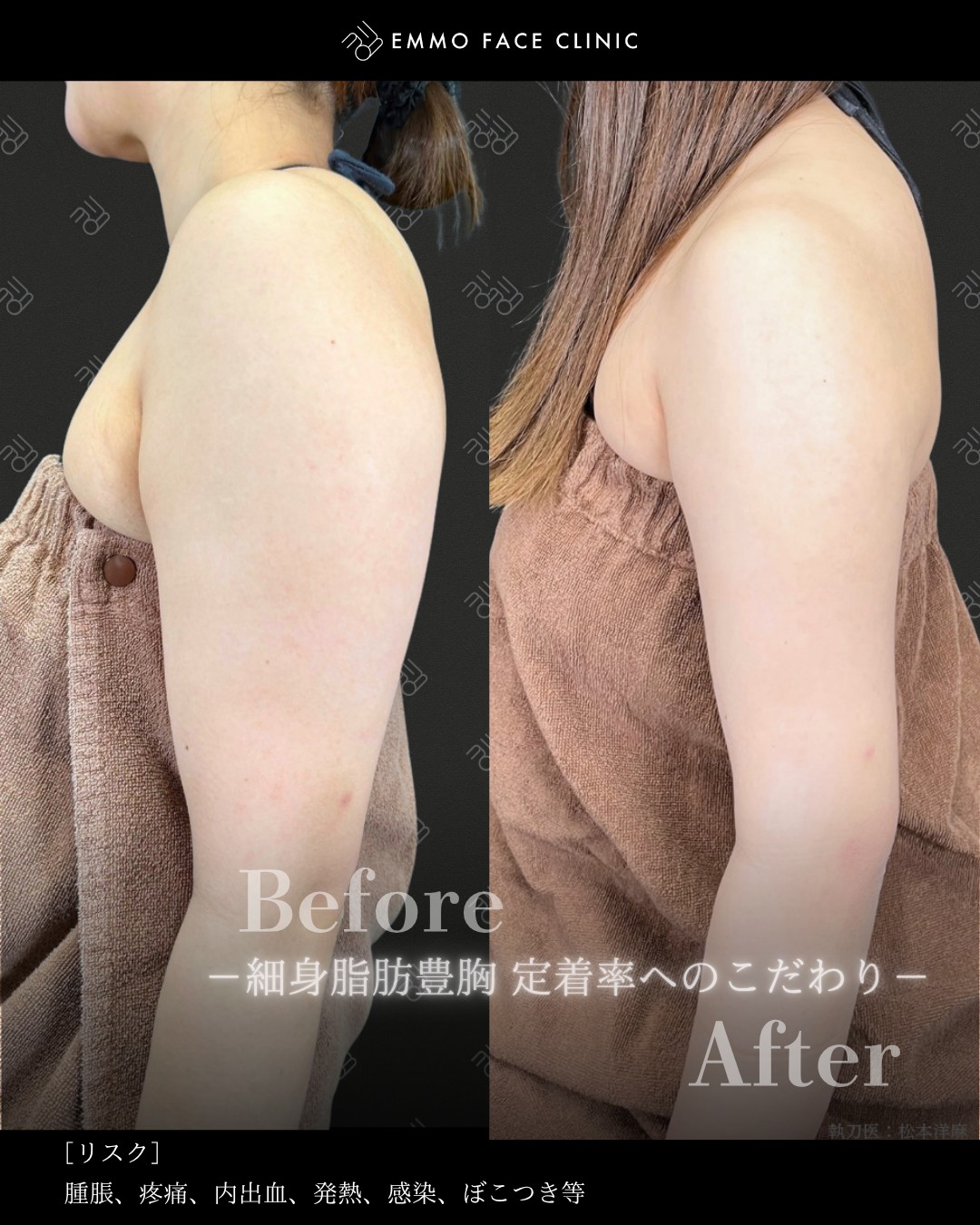 二の腕脂肪吸引ー症例写真