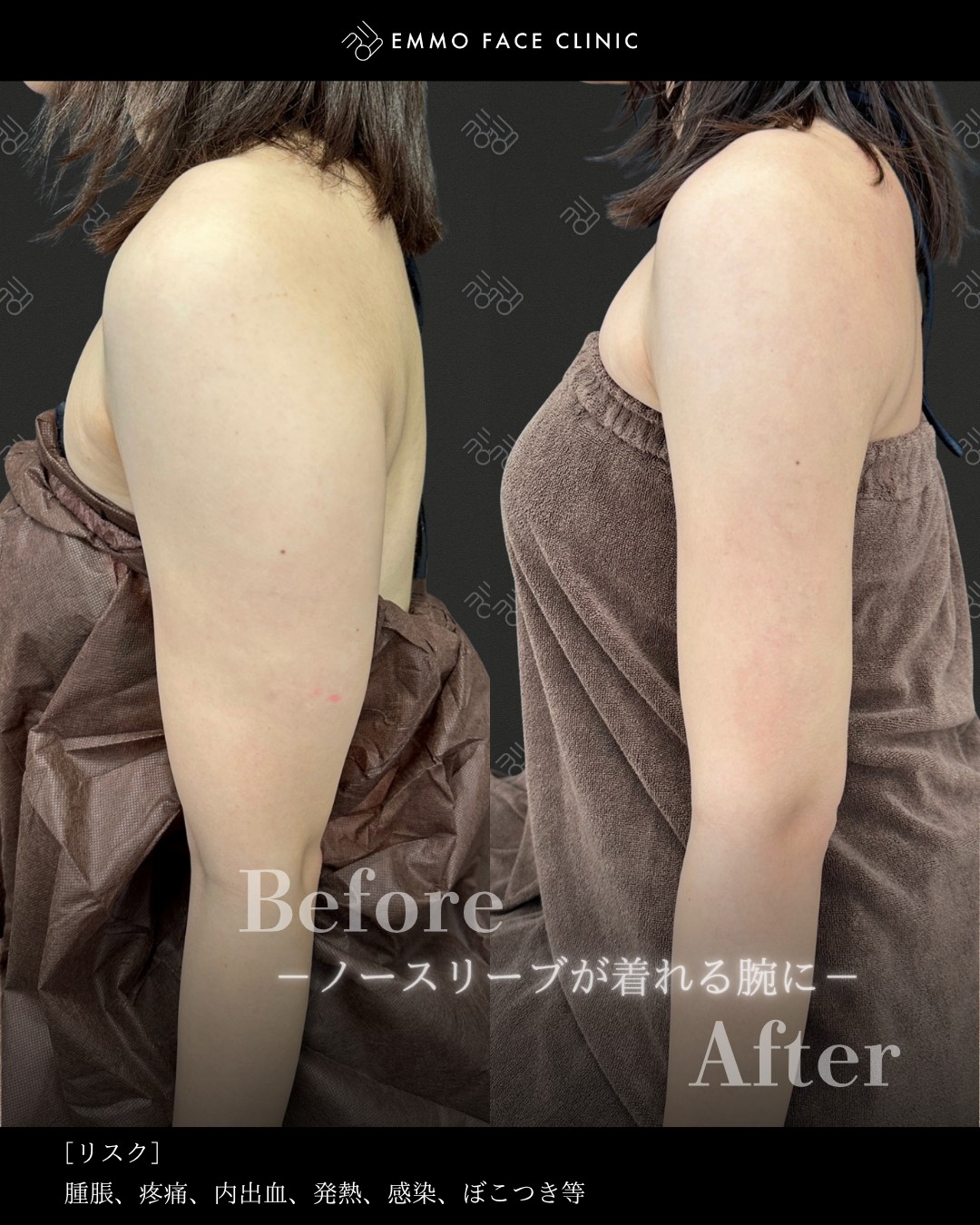 二の腕ー脂肪吸引