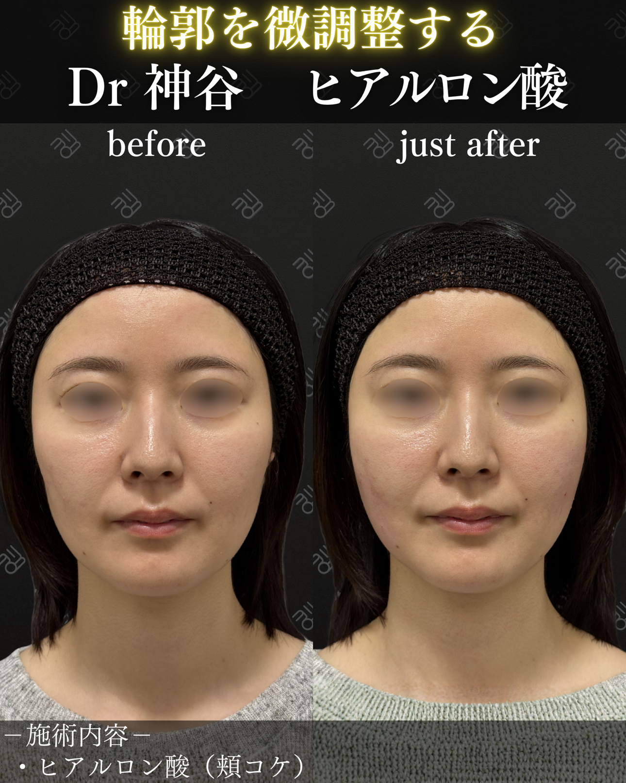 ヒアルロン酸ー症例写真