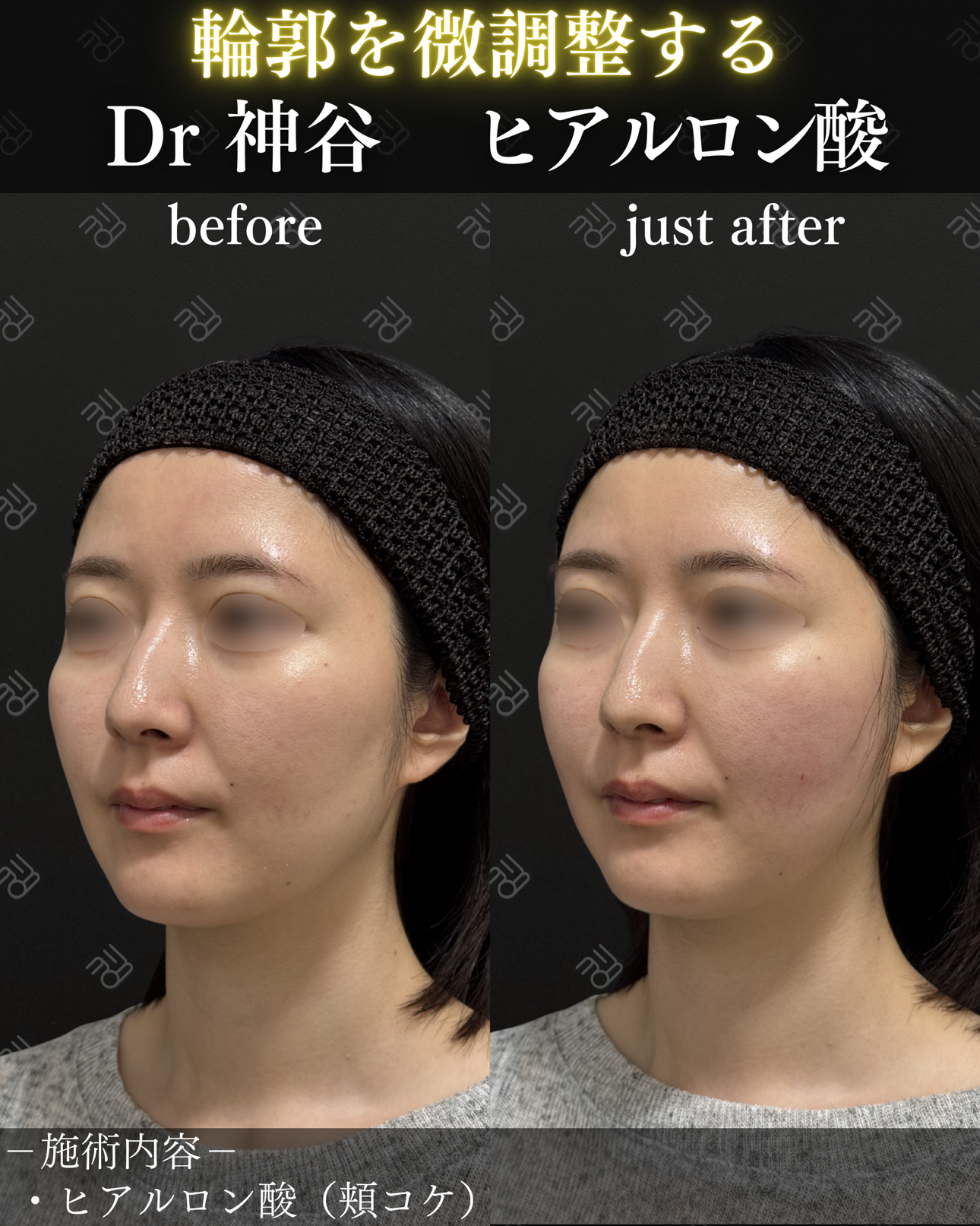ヒアルロン酸ー症例写真