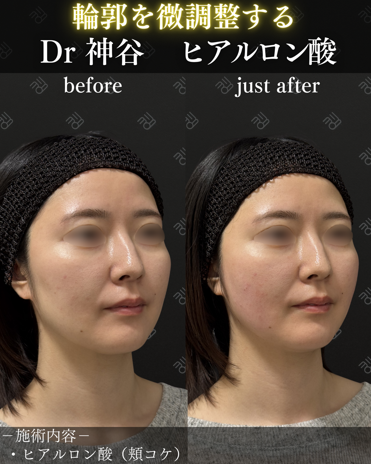 ヒアルロン酸ー症例写真