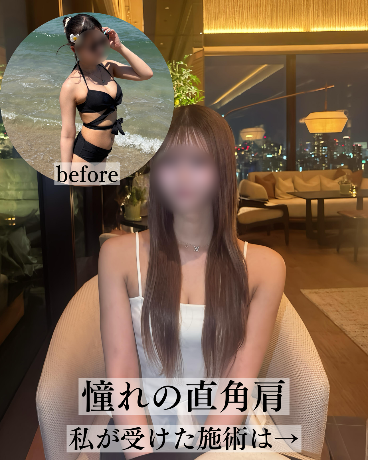 二の腕脂肪吸引ー症例写真