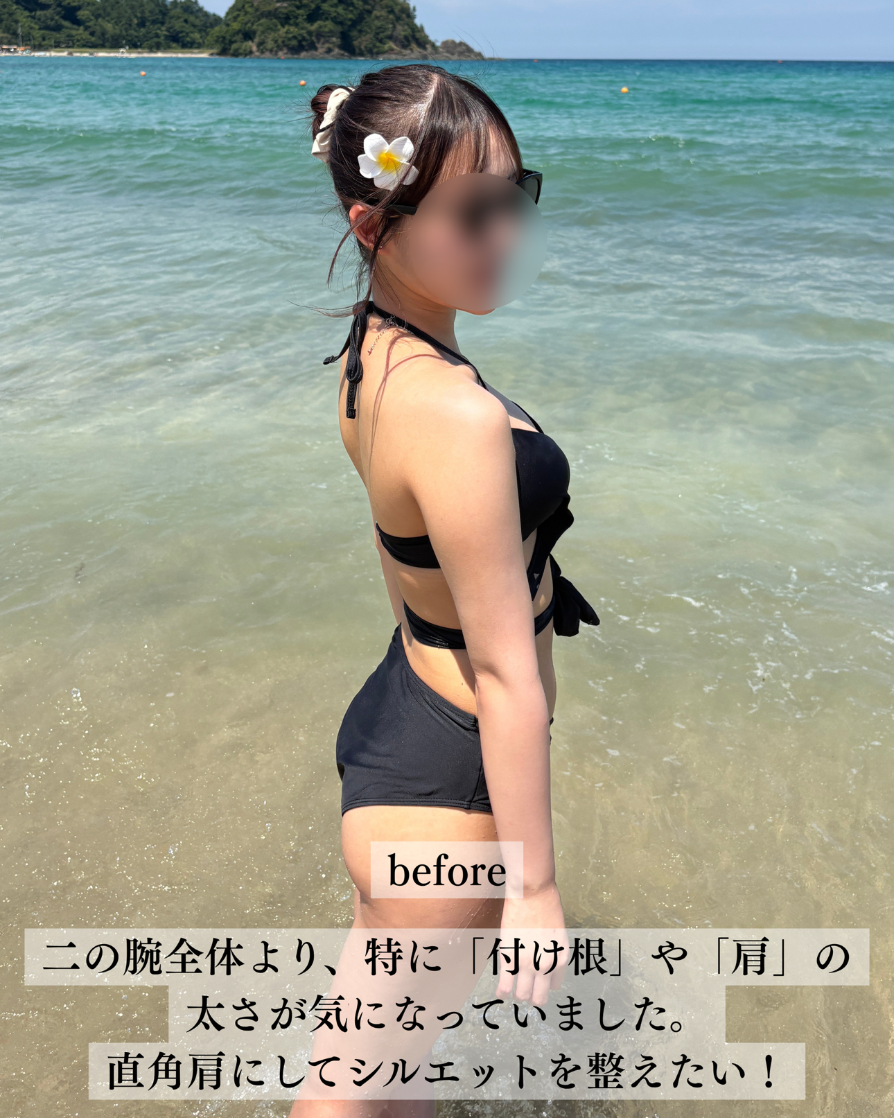 二の腕脂肪吸引ー症例写真