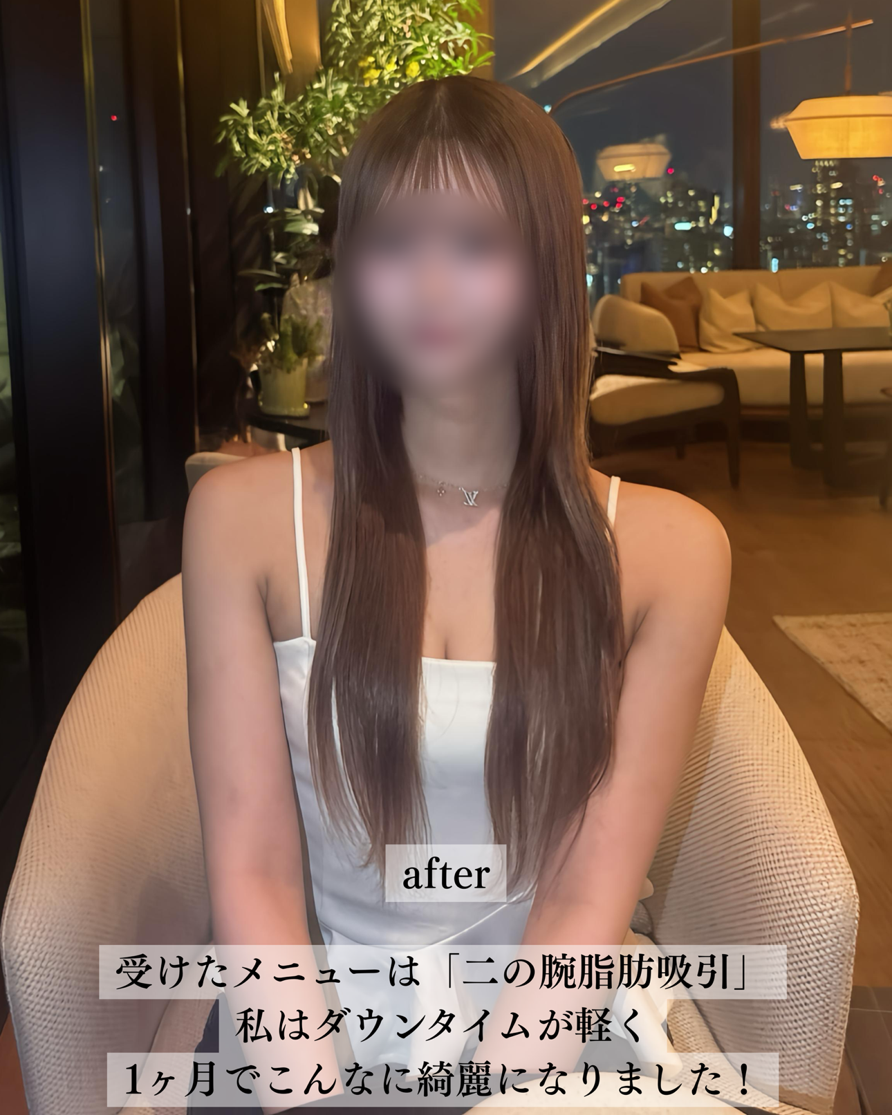 二の腕脂肪吸引ー症例写真