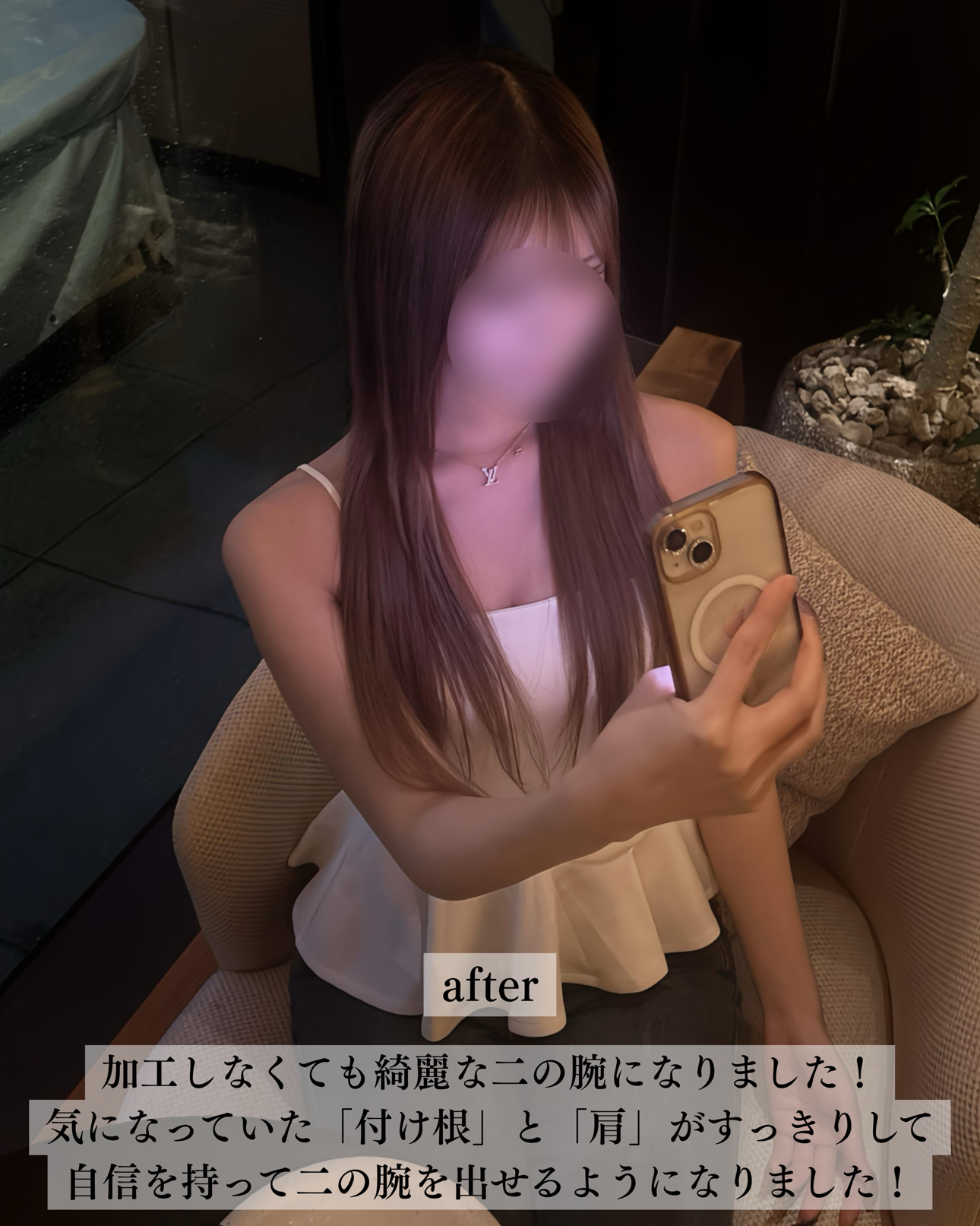 二の腕脂肪吸引ー症例写真