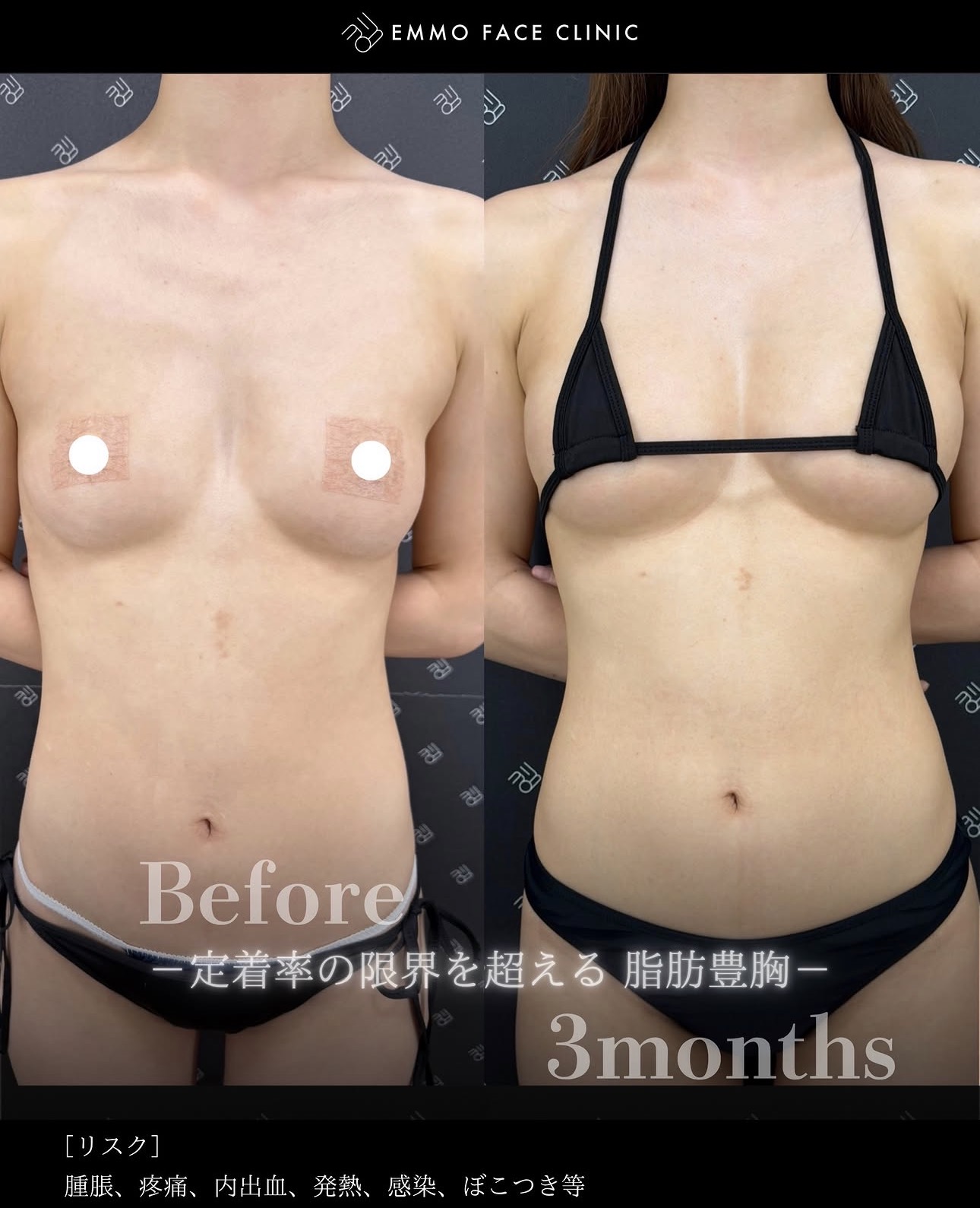 脂肪豊胸ー症例写真