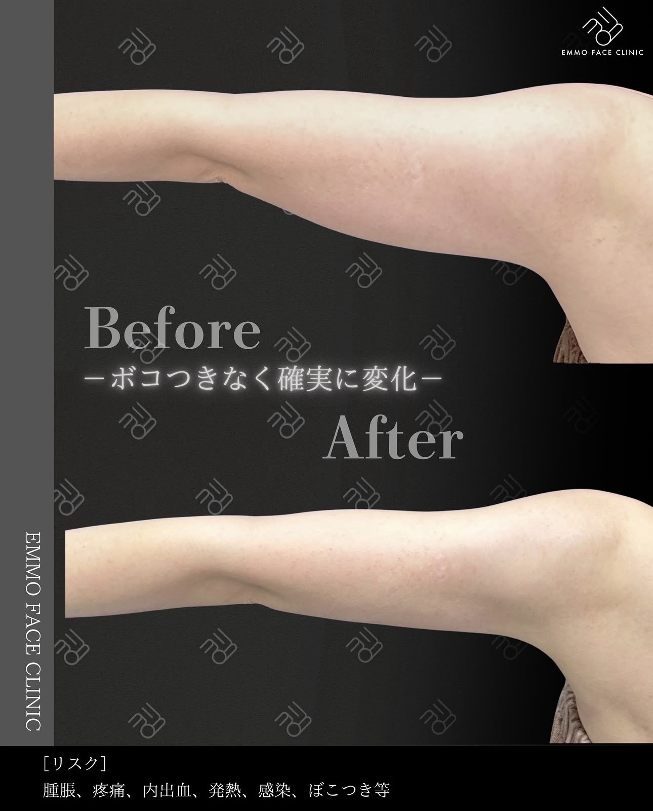 二の腕脂肪吸引ー症例写真
