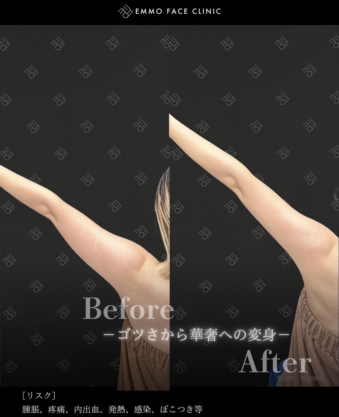 二の腕脂肪吸引ー症例写真