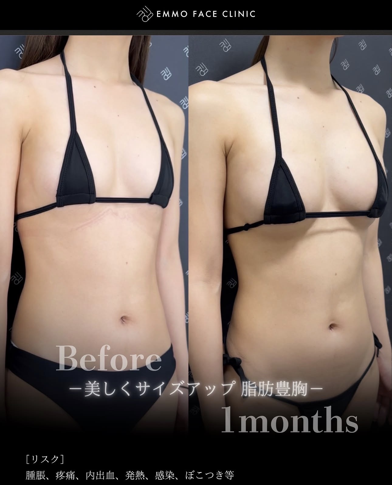 豊胸ー症例写真