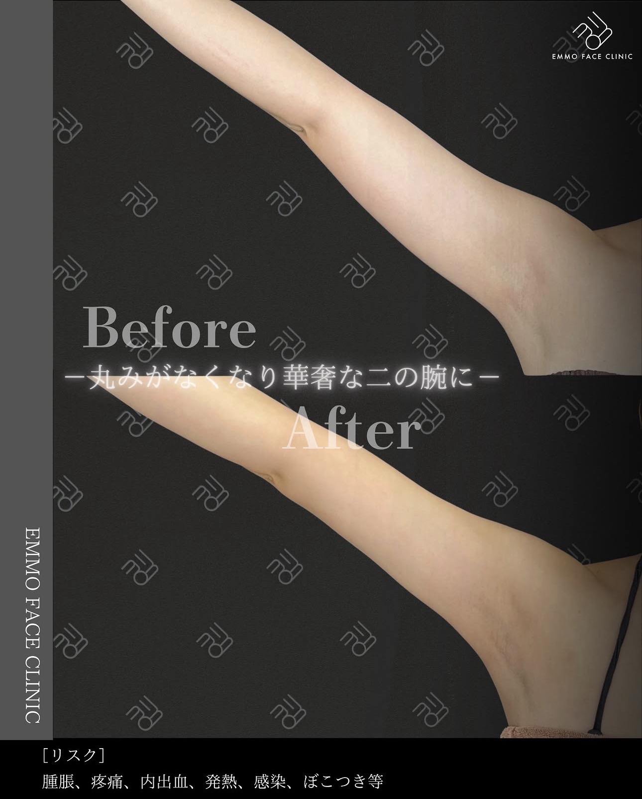 豊胸ー症例写真